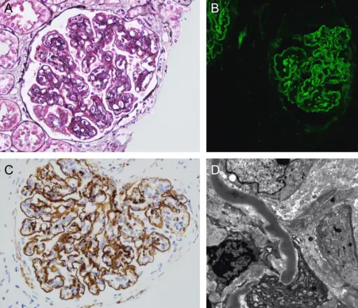 Dense Deposit Disease