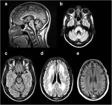 Dentatorubral-Pallidoluysian Atrophy