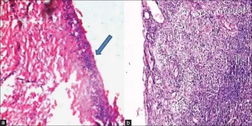 Dentigerous Cyst