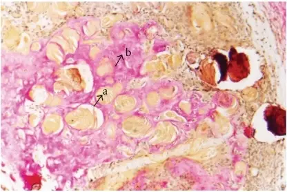 Dentinogenic Ghost Cell Tumor