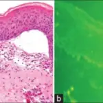 Dermatitis Herpetiformis