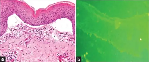 Dermatitis Herpetiformis