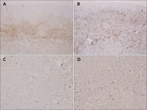 Dermatofibroma