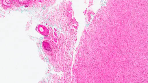 Dermatofibrosarcoma Protuberans