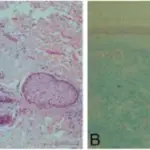 Dermatomyositis