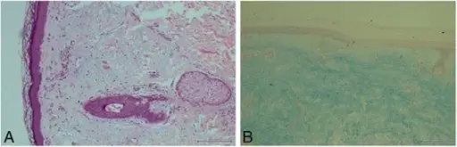 Dermatomyositis