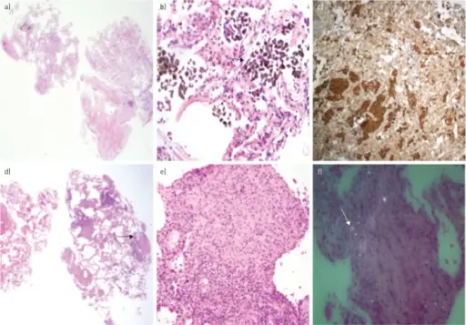 Desquamative Interstitial Pneumonia