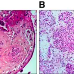 Diabetes due to Insulin Receptor Defects