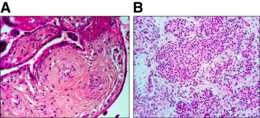 Diabetes due to Insulin Receptor Defects