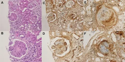 Diabetic Nephropathy