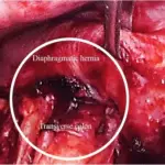 Diaphragmatic Hernia