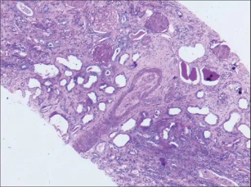 Diffuse Cortical Necrosis