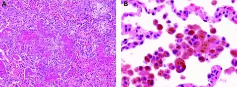 Diffuse Pulmonary Hemorrhage Syndromes