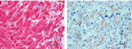 Diphtheria Infectious Neuropathy