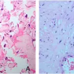 Disorders of Blood Vessels