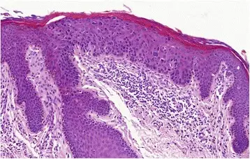 Disorders of Epidermal Maturation