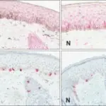 Disorders of Pigmentation and Melanocytes