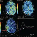 Disruption of Normal Blood Flow