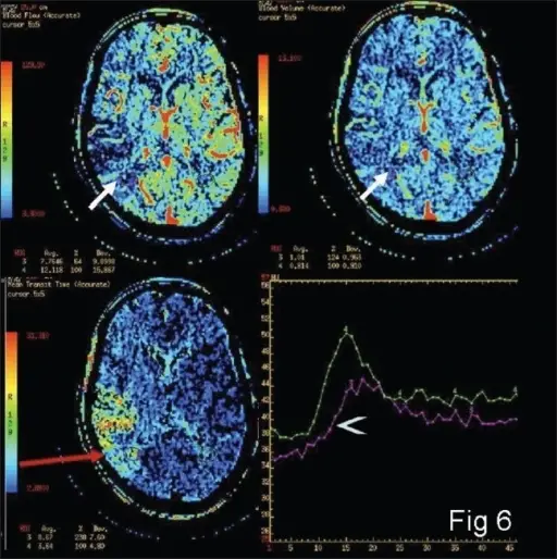 Disruption of Normal Blood Flow