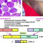 Disseminated Intravascular Coagulation