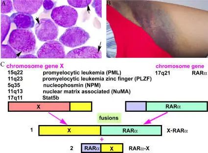 Disseminated Intravascular Coagulation