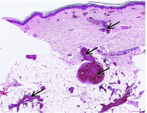 Disseminated Intravascular Coagulation
