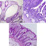 Diversion Colitis