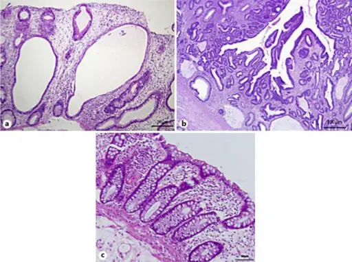 Diversion Colitis