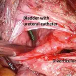 Diverticula of the Bladder