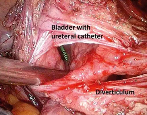 Diverticula of the Bladder