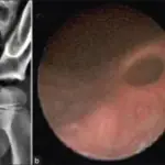 Diverticula of the Ureter