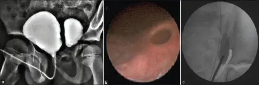 Diverticula of the Ureter