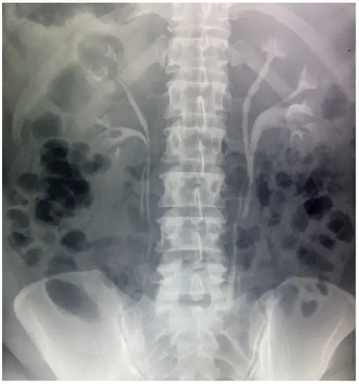 Double ureters