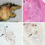 Ductal Adenocarcinomas