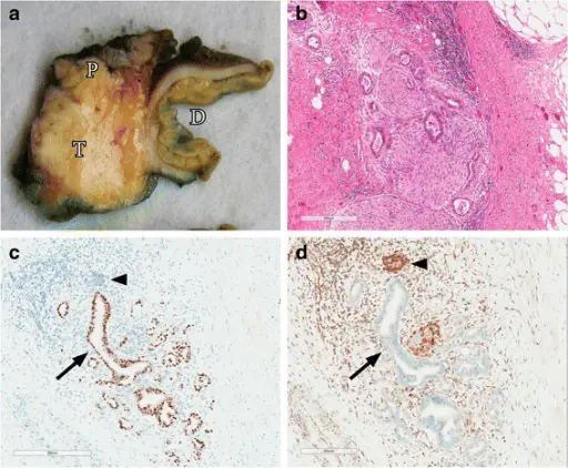 Ductal Adenocarcinomas