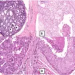 Ductal Carcinoma in Situ