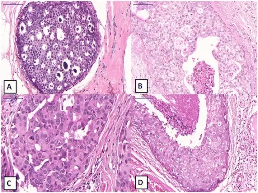 Ductal Carcinoma in Situ