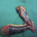 Duplication of the Gallbladder