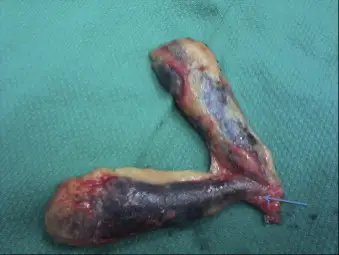 Duplication of the Gallbladder