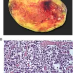 Dysgerminoma of the Ovary