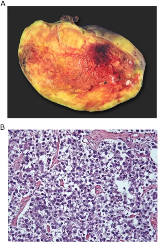 Dysgerminoma of the Ovary