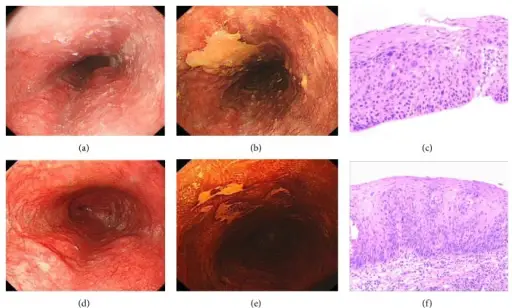 Dysplasia