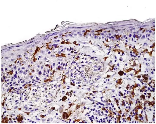 Dysplastic Nevus