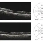 END STAGE EYE