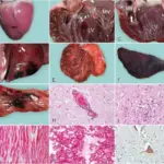 Ecchymosis