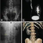 Ectopic Kidney