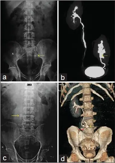 Ectopic Kidney