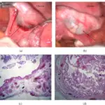 Ectopic Pregnancy