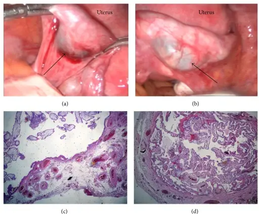 Ectopic Pregnancy