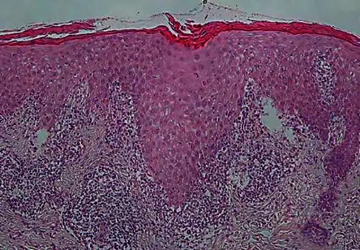 Eczematous Dermatitis